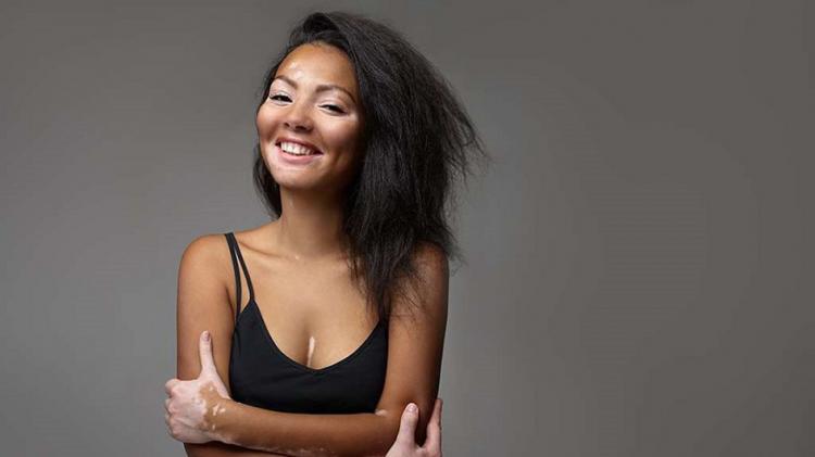 Vitiligo: tratamento realizado no CRDT trabalha a autoestima dos pacientes